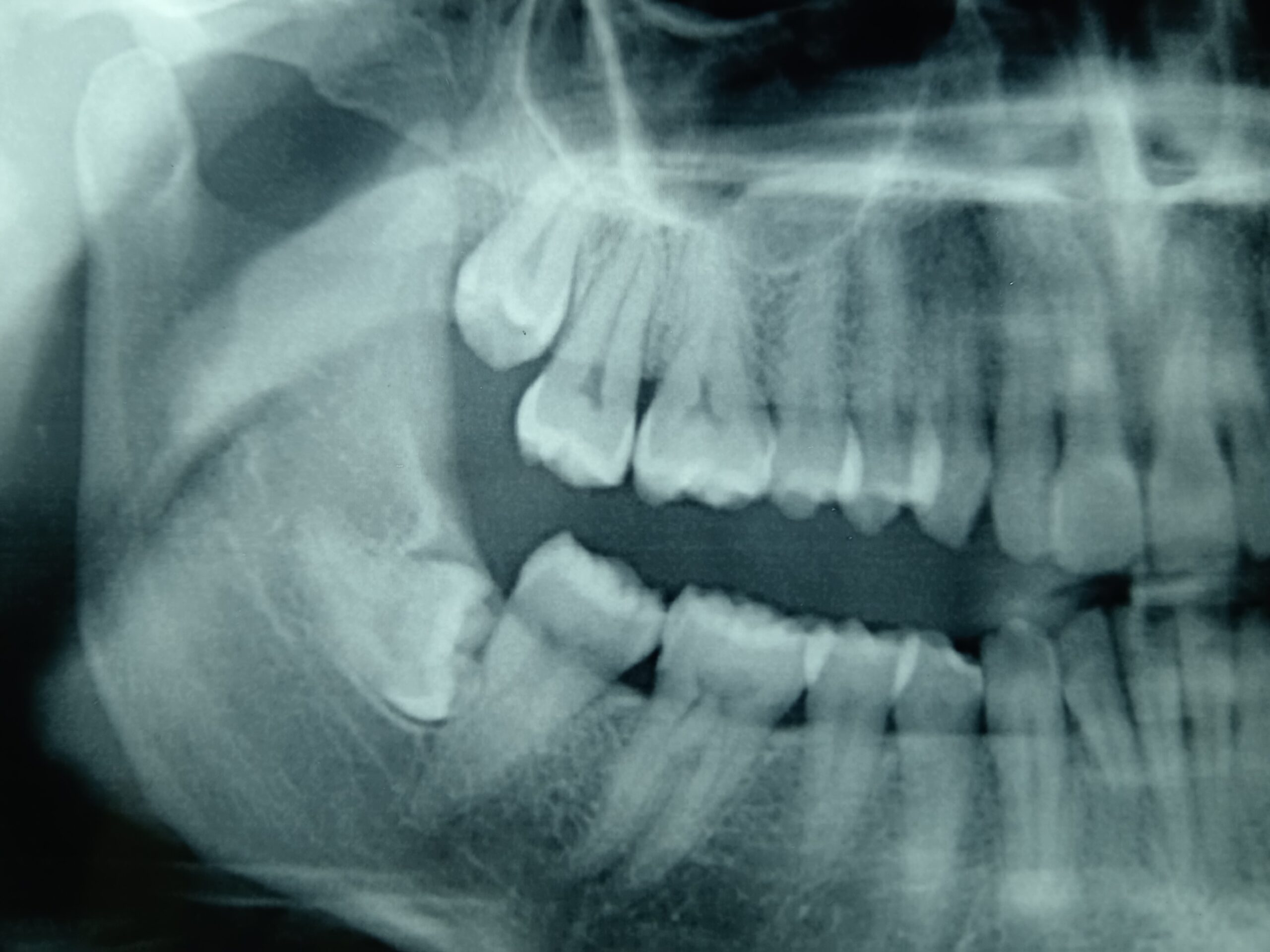 Dott.ssa Emanuela Muratore | Implantologia dentale a Bellaria: prima dell’intervento – Caso 2