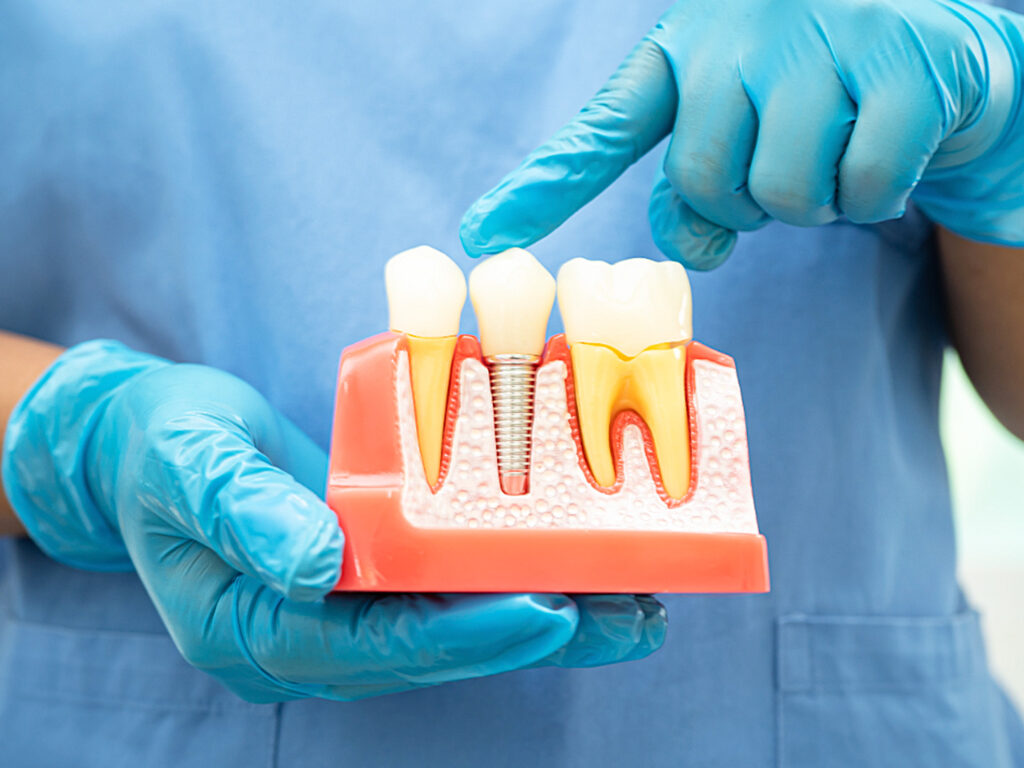 Protesi e Implantologia a Bellaria