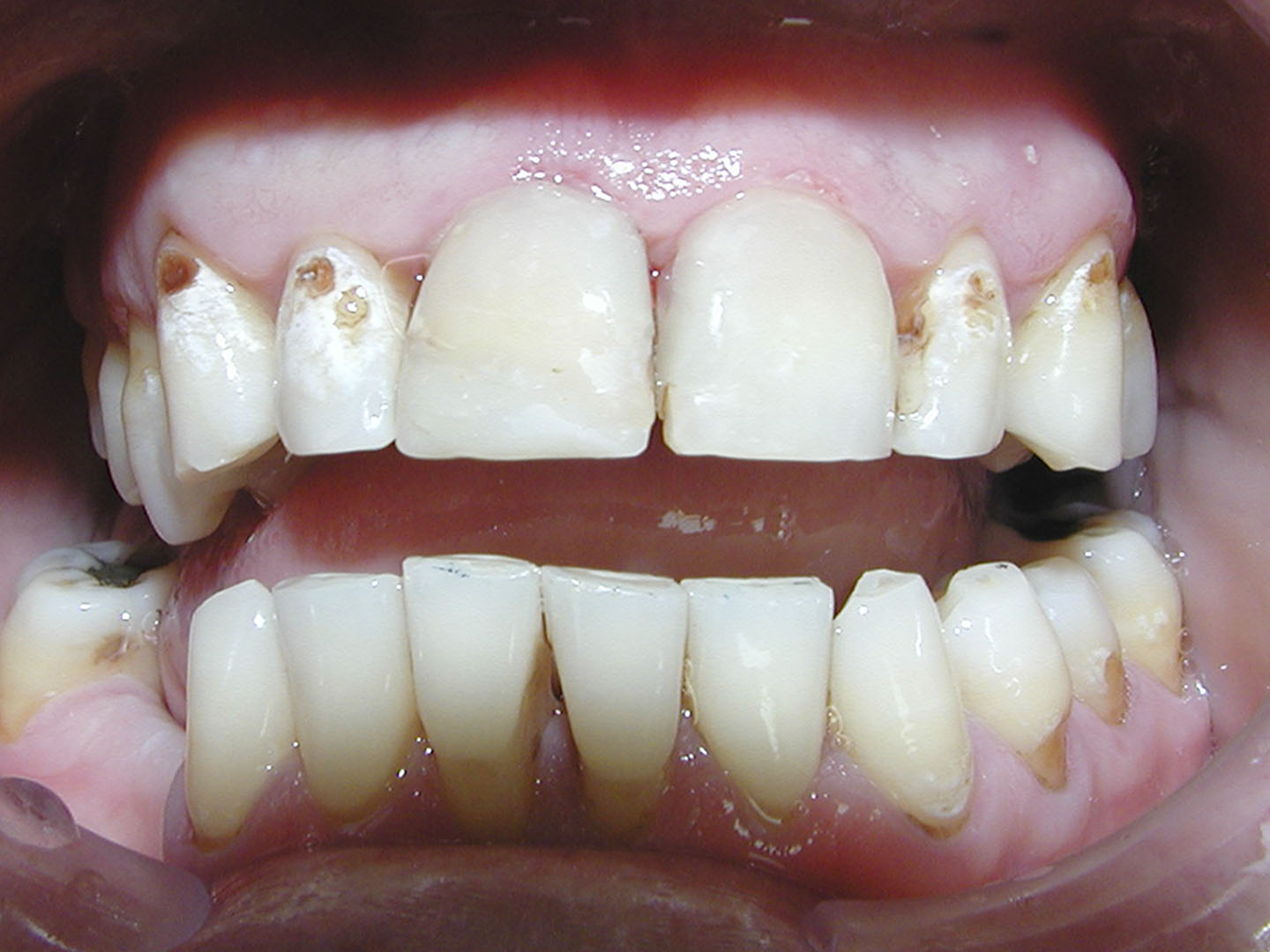 Dott.ssa Emanuela Muratore | Cura carie a Bellaria: dopo l’intervento – Caso 1