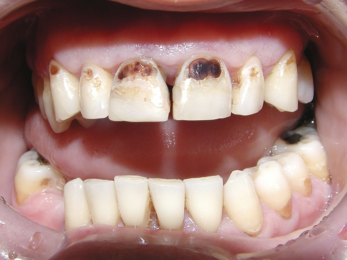 Dott.ssa Emanuela Muratore | Cura carie a Bellaria: prima dell’intervento – Caso 2