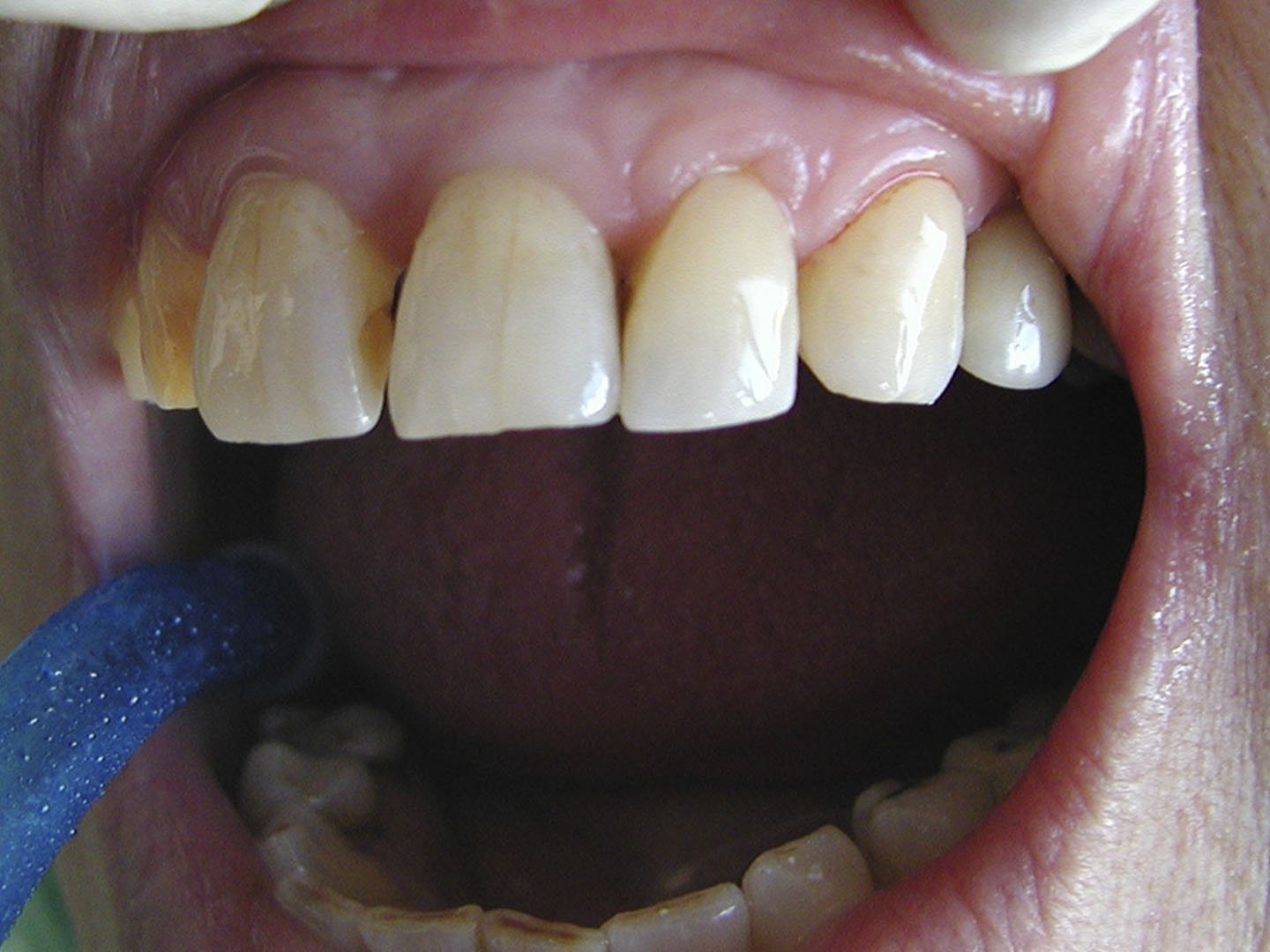 Dott.ssa Emanuela Muratore | Cura carie a Bellaria: dopo l’intervento – Caso 2