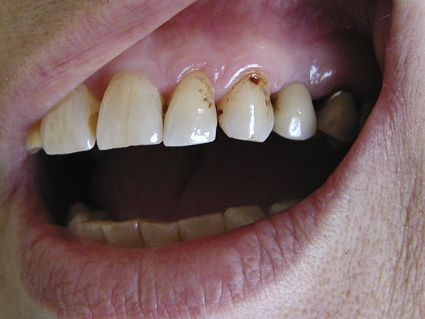 Dott.ssa Emanuela Muratore | Cura carie a Bellaria: prima dell’intervento – Caso 2