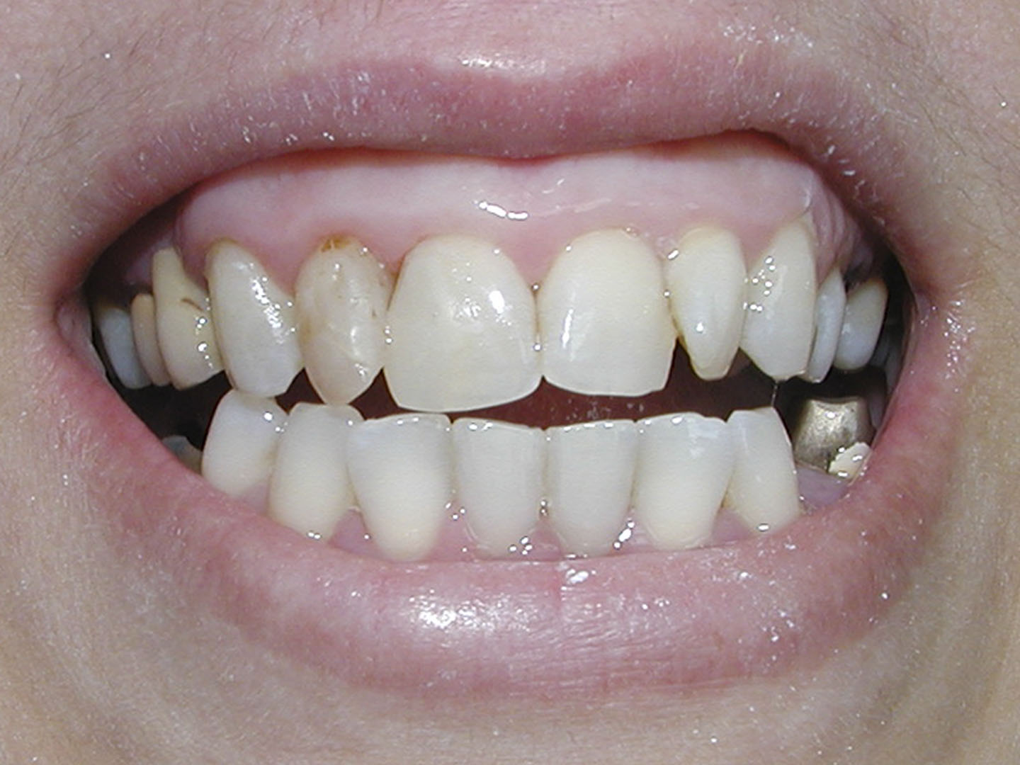 Dott.ssa Emanuela Muratore | Cura carie a Bellaria: dopo l’intervento – Caso 3