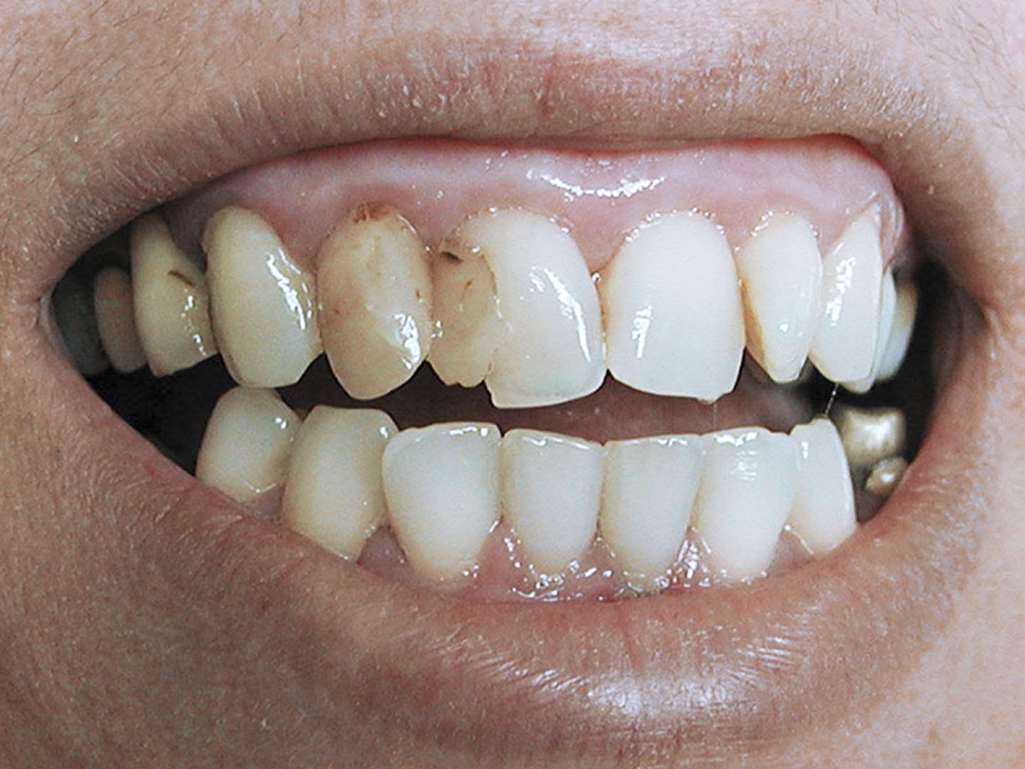 Dott.ssa Emanuela Muratore | Cura carie a Bellaria: prima dell’intervento – Caso 3