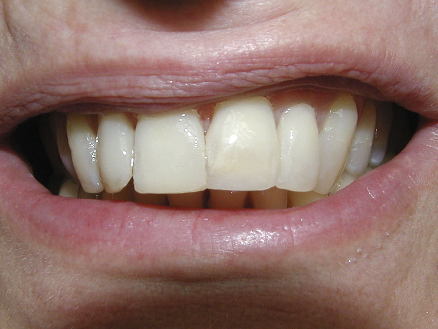 Dott.ssa Emanuela Muratore | Estetica Dentale a Bellaria: dopo l’intervento – Caso 1