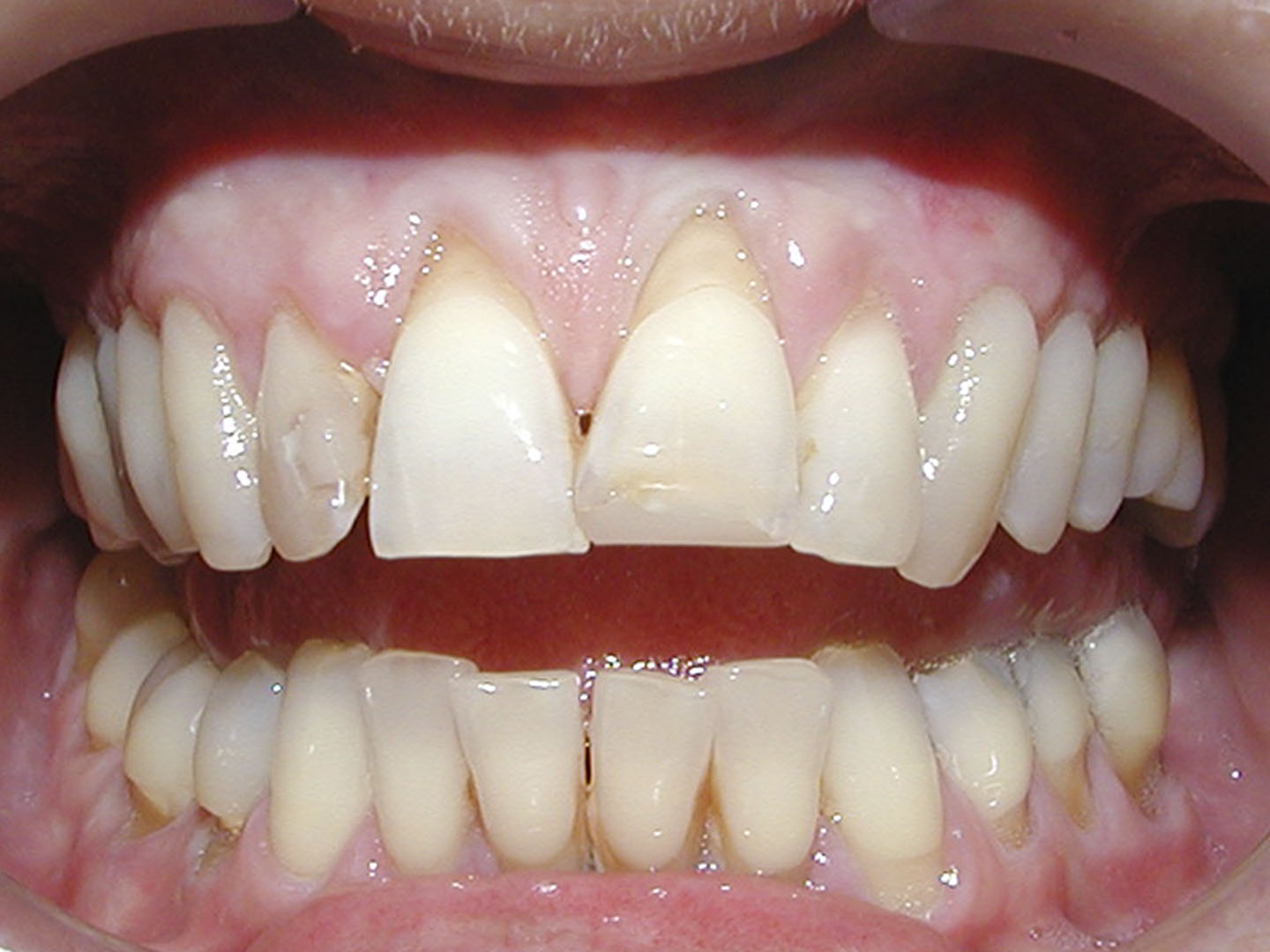 Dott.ssa Emanuela Muratore | Estetica Dentale a Bellaria: prima dell’intervento – Caso 1