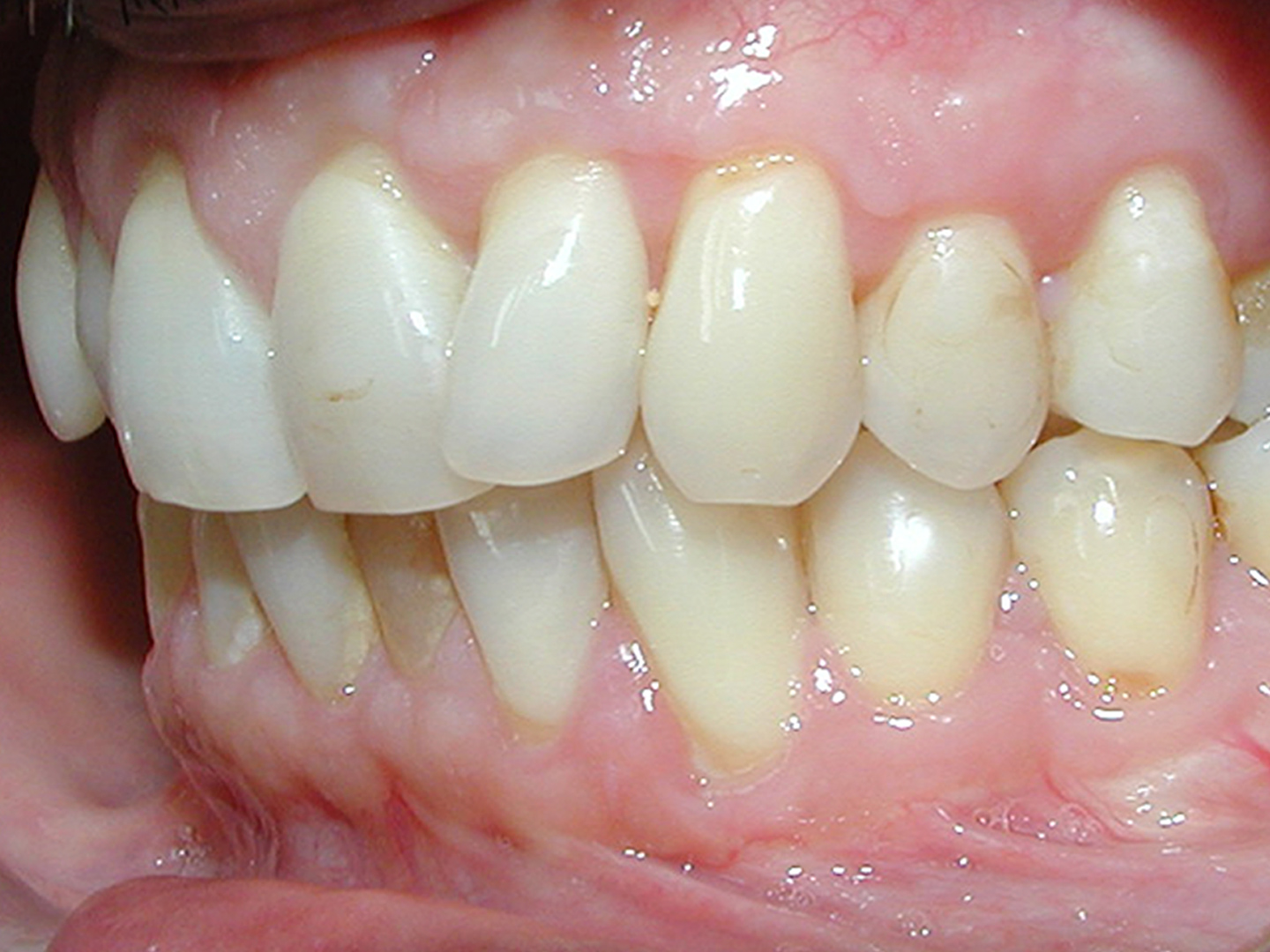 Dott.ssa Emanuela Muratore | Estetica Dentale a Bellaria: dopo l’intervento – Caso 2