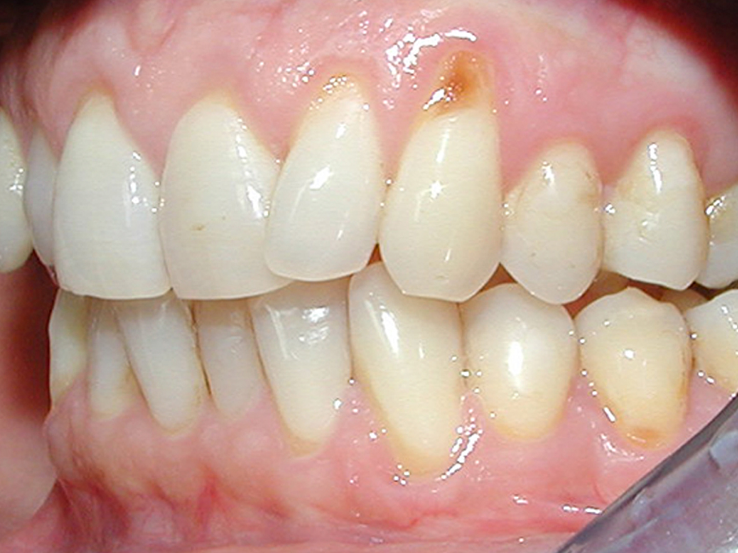 Dott.ssa Emanuela Muratore | Estetica Dentale a Bellaria: prima dell’intervento – Caso 2