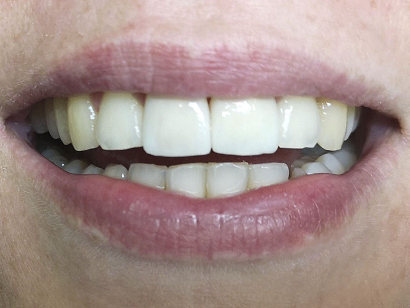 Dott.ssa Emanuela Muratore | Estetica Dentale a Bellaria: dopo l’intervento – Caso 3