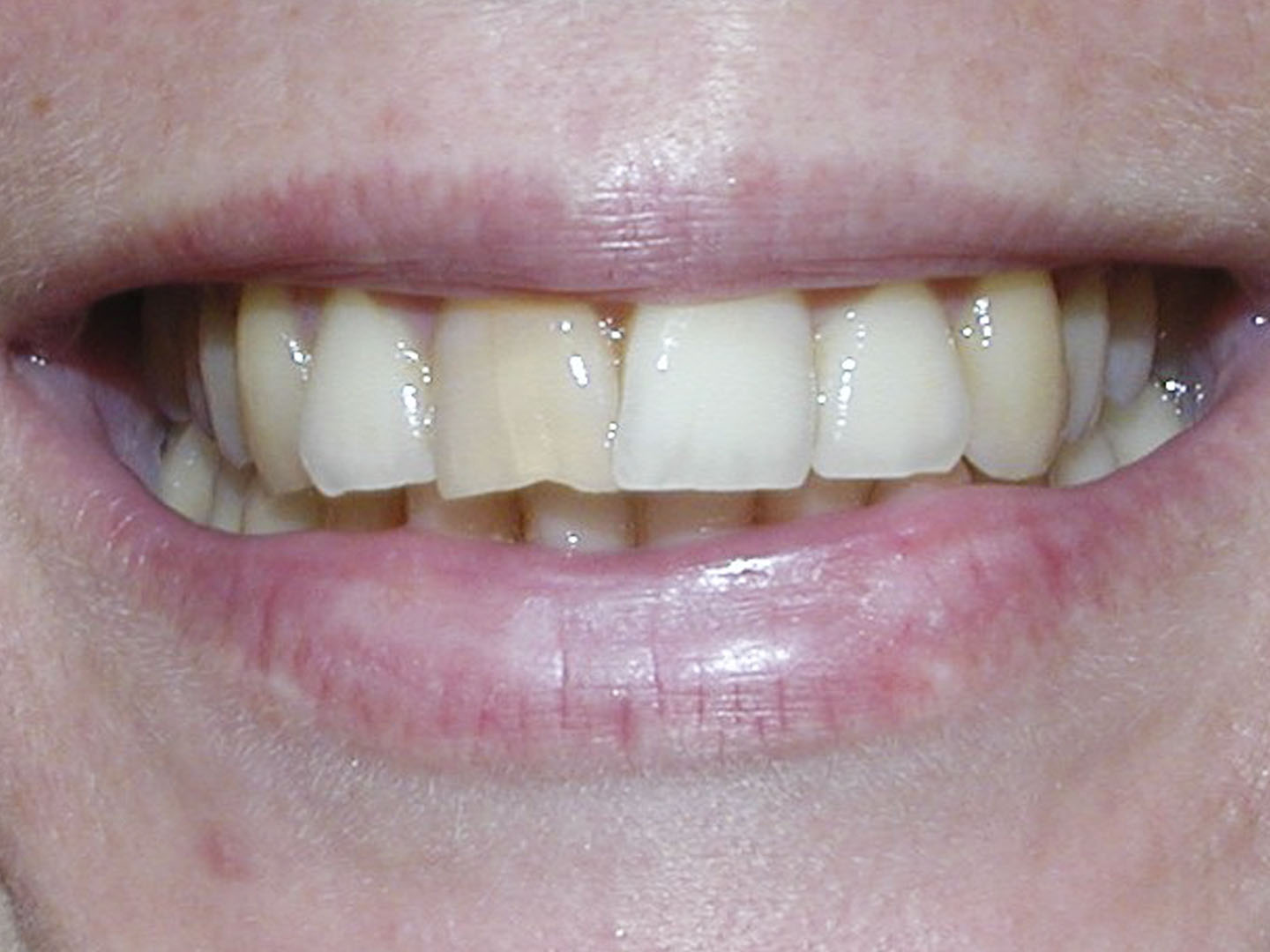 Dott.ssa Emanuela Muratore | Estetica Dentale a Bellaria: prima dell’intervento – Caso 3