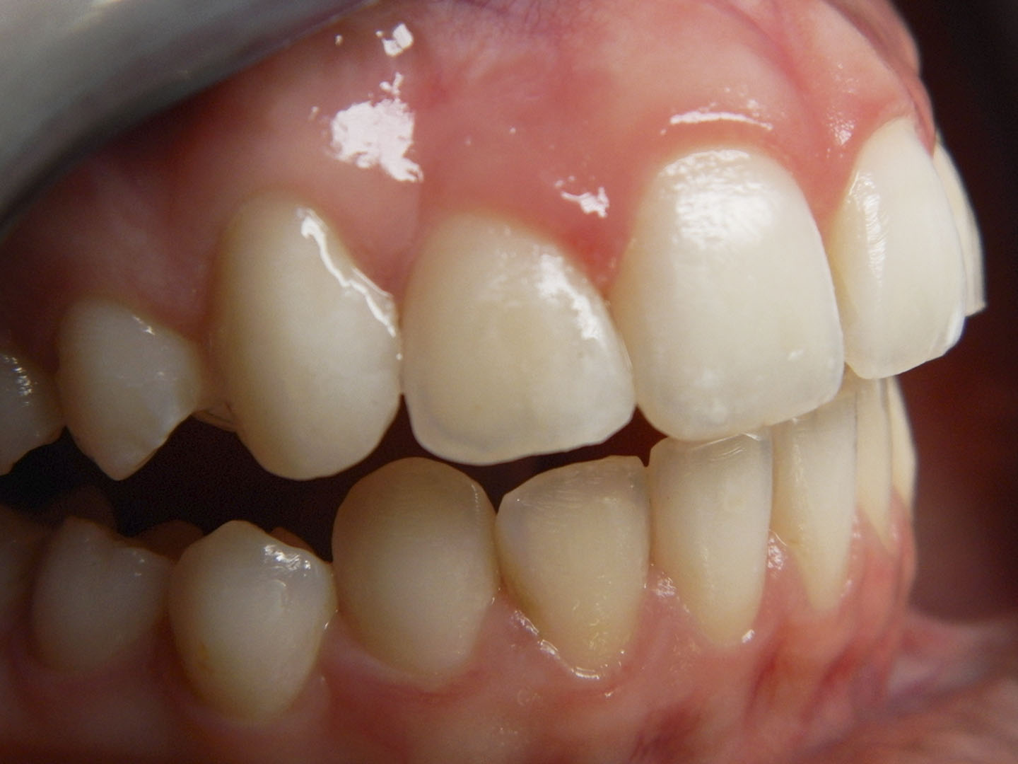 Dott.ssa Emanuela Muratore | Estetica Dentale a Bellaria: dopo l’intervento – Caso 4