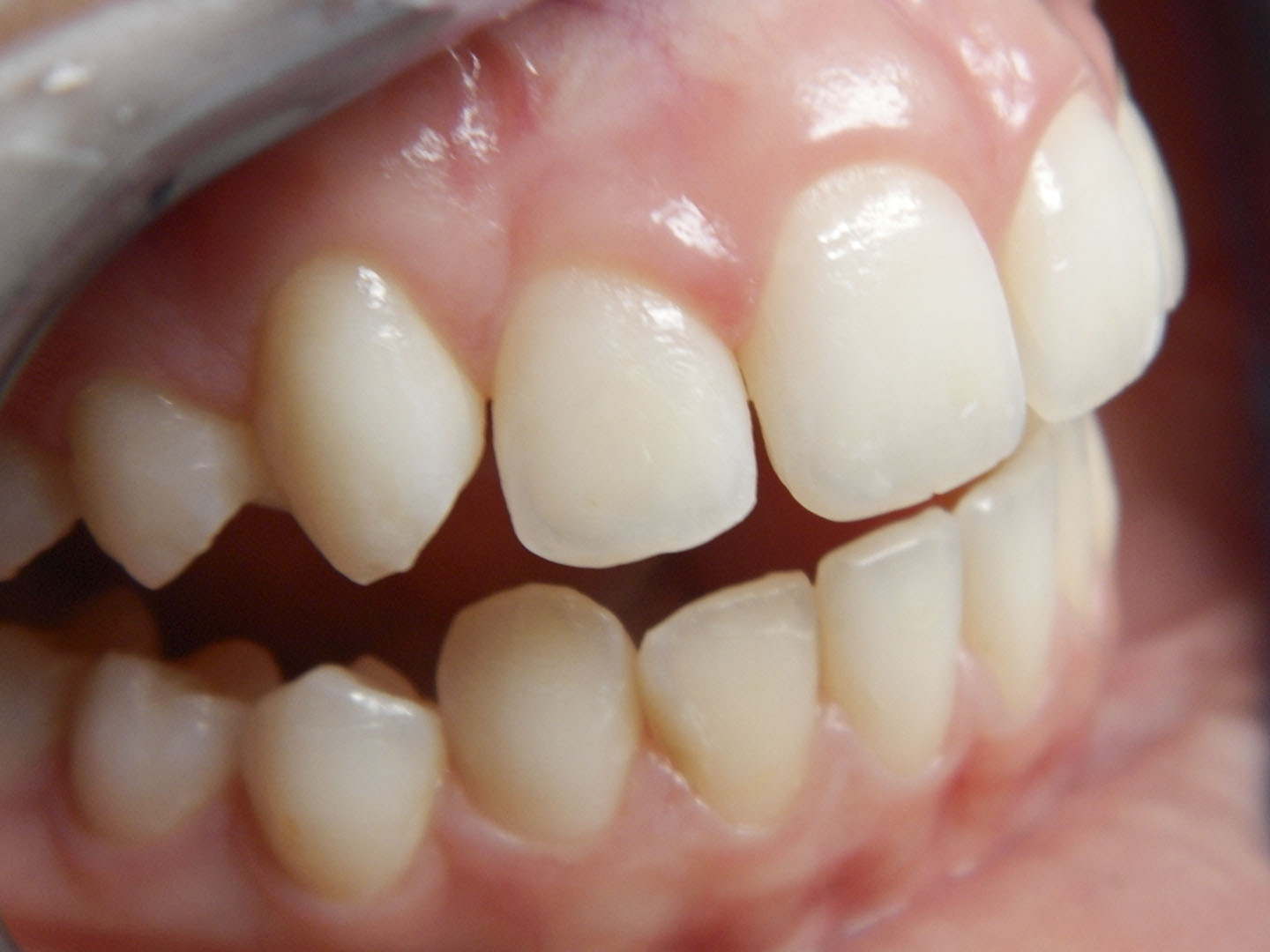 Dott.ssa Emanuela Muratore | Estetica Dentale a Bellaria: prima dell’intervento – Caso 4