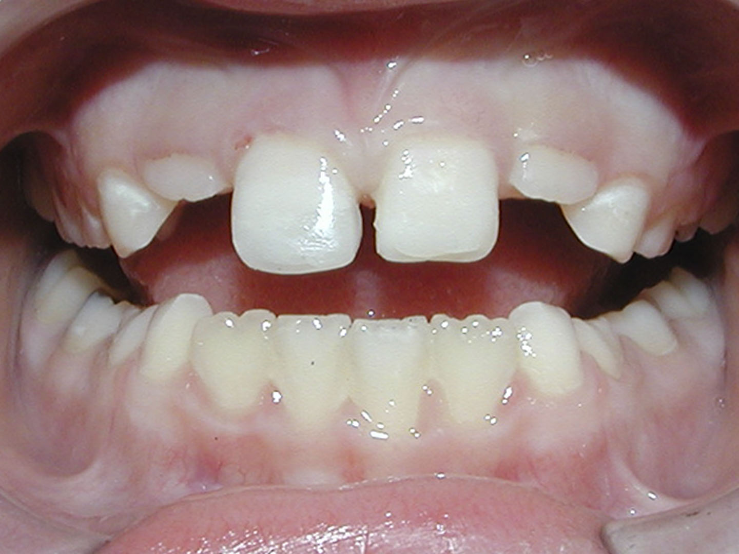 Dott.ssa Emanuela Muratore | Estetica Dentale a Bellaria: dopo l’intervento – Caso 1