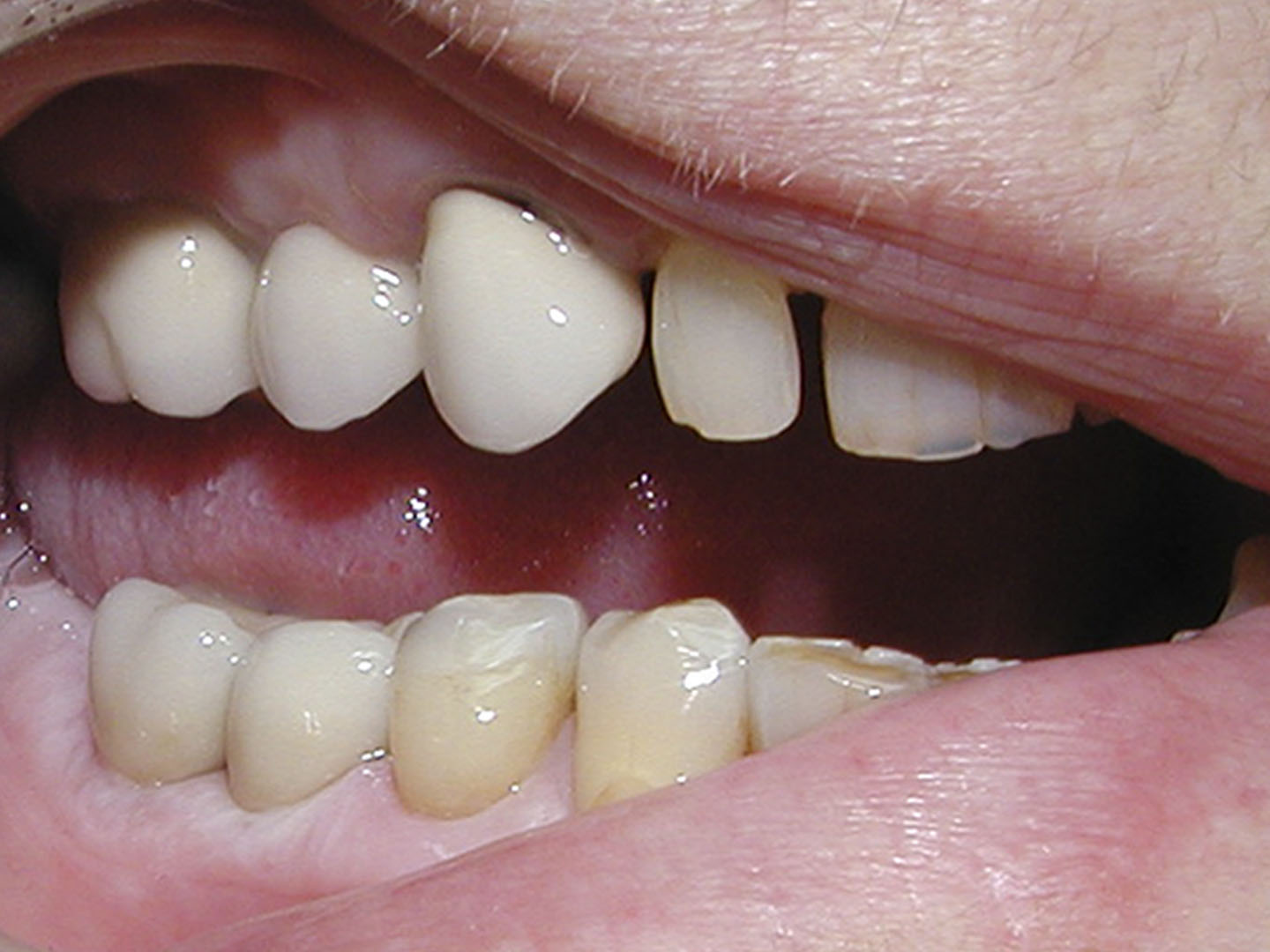 Dott.ssa Emanuela Muratore | Implantologia dentale a Bellaria: dopo l’intervento – Caso 2