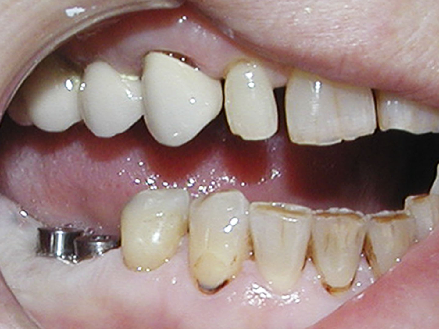 Dott.ssa Emanuela Muratore | Implantologia dentale a Bellaria: prima dell’intervento – Caso 2