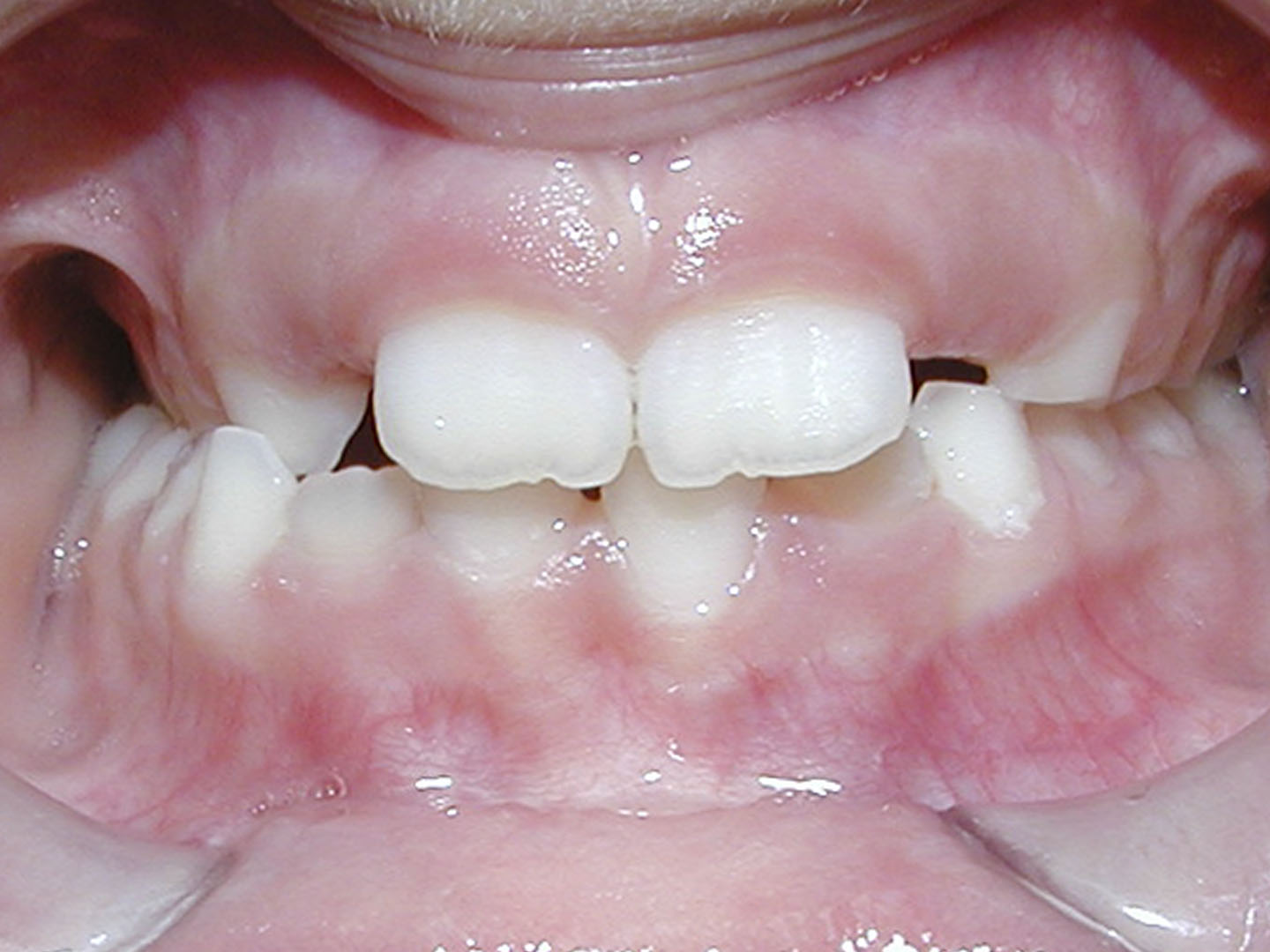 Dott.ssa Emanuela Muratore | Ortodonzia Dentale a Bellaria: prima dell’intervento – Caso 1