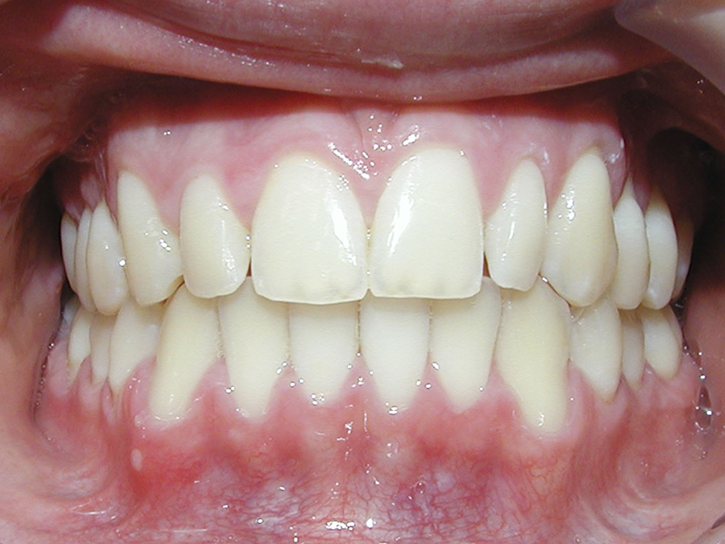 Dott.ssa Emanuela Muratore | Ortodonzia Dentale a Bellaria: dopo l’intervento – Caso 2