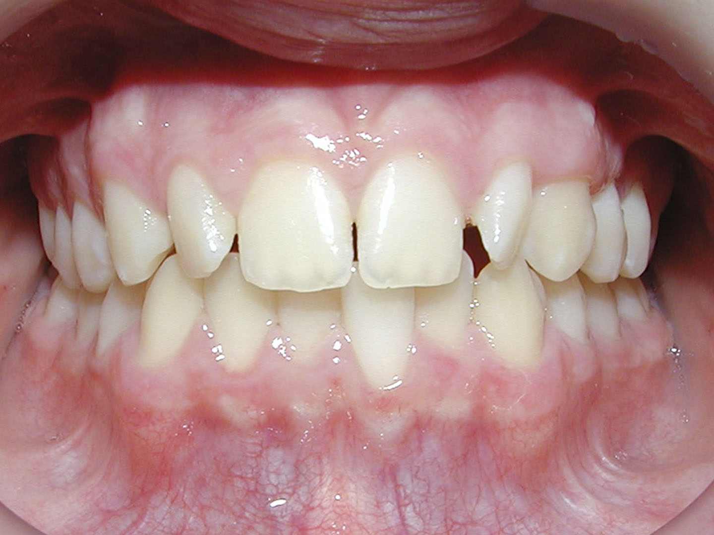 Dott.ssa Emanuela Muratore | Ortodonzia Dentale a Bellaria: prima dell’intervento – Caso 2