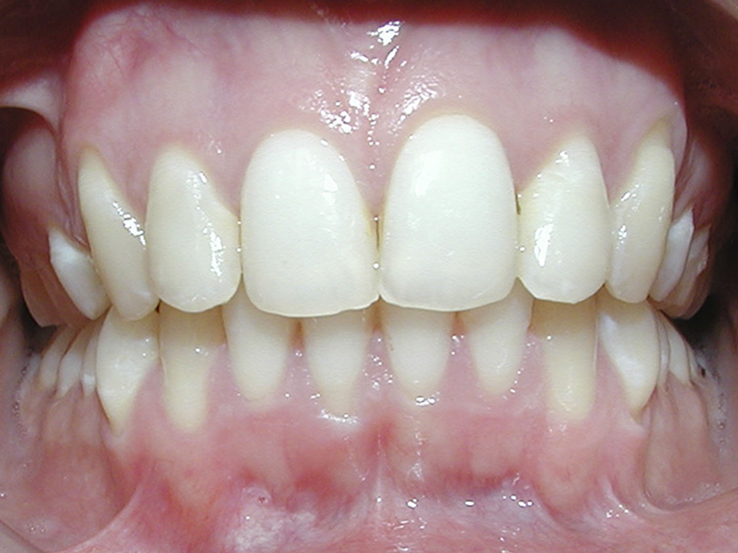 Dott.ssa Emanuela Muratore | Ortodonzia Dentale a Bellaria: dopo l’intervento – Caso 3