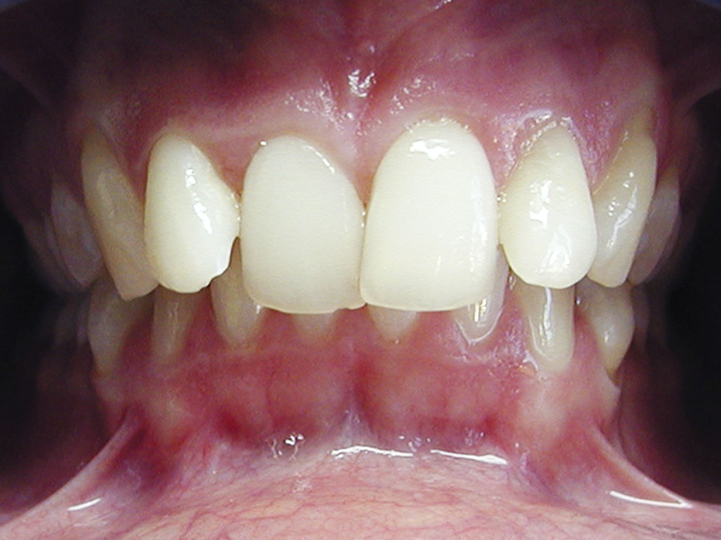 Dott.ssa Emanuela Muratore | Ortodonzia Dentale a Bellaria: prima dell’intervento – Caso 3