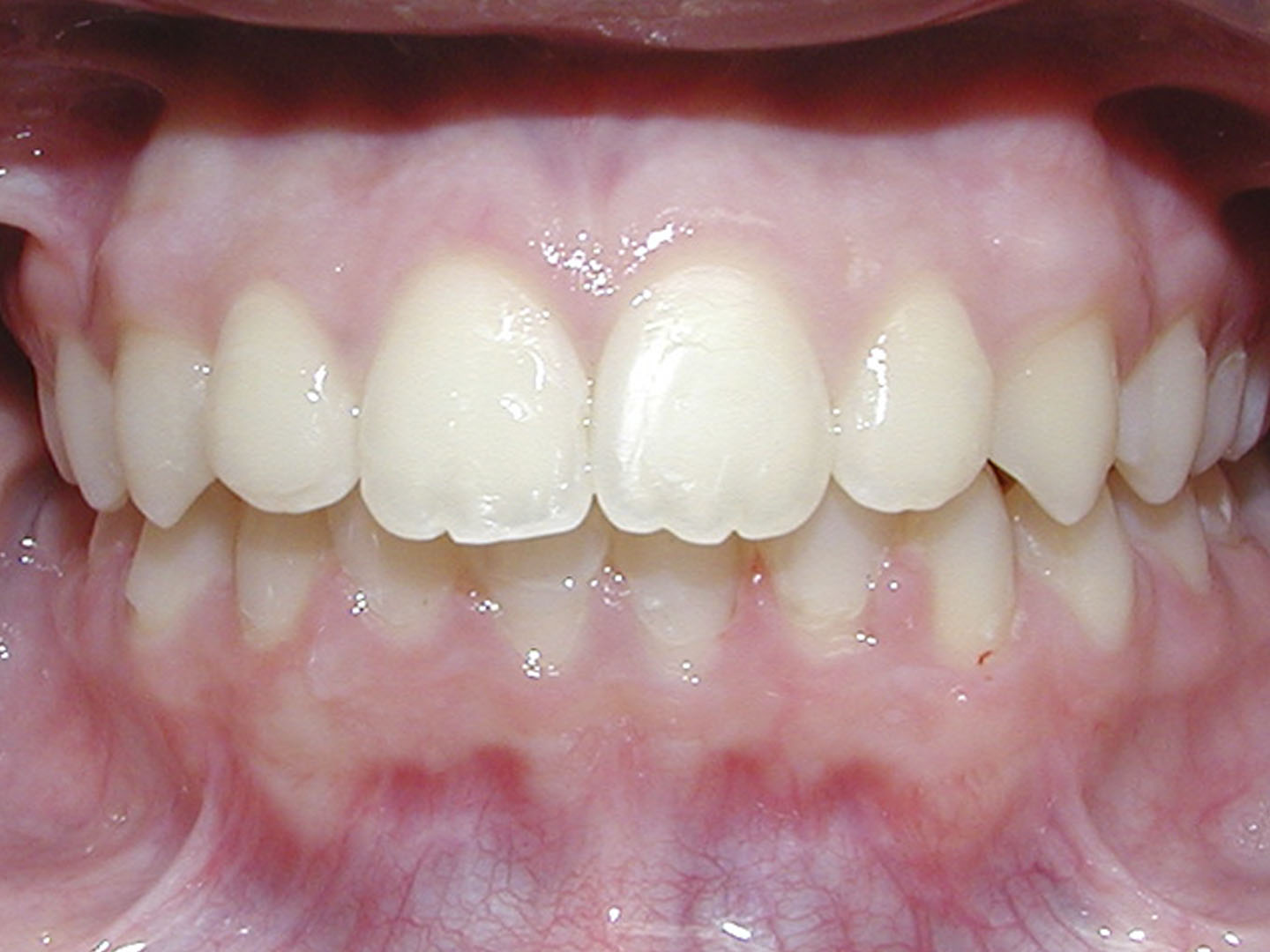 Dott.ssa Emanuela Muratore | Ortodonzia Dentale a Bellaria: dopo l’intervento – Caso 4