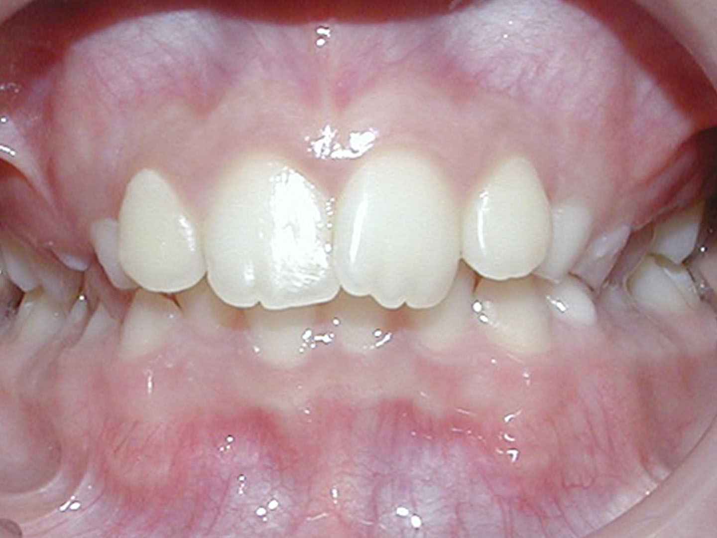 Dott.ssa Emanuela Muratore | Ortodonzia Dentale a Bellaria: prima dell’intervento – Caso 4