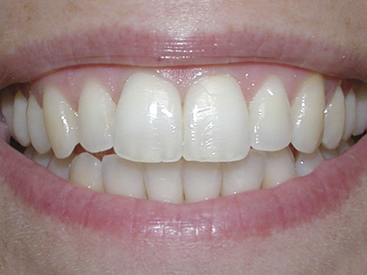 Dott.ssa Emanuela Muratore | Ortodonzia Dentale a Bellaria: dopo l’intervento – Caso 5