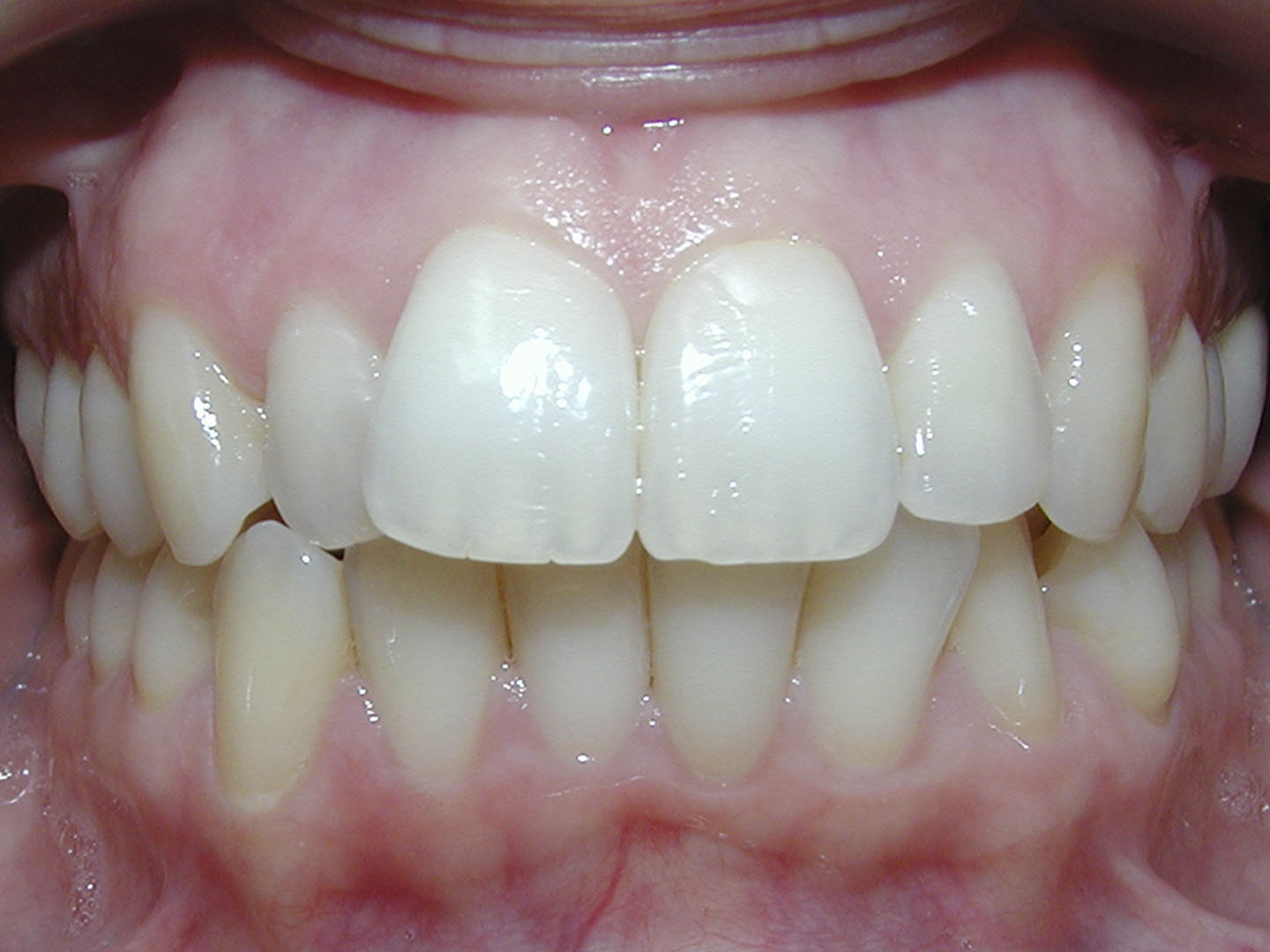 Dott.ssa Emanuela Muratore | Ortodonzia Dentale a Bellaria: prima dell’intervento – Caso 5