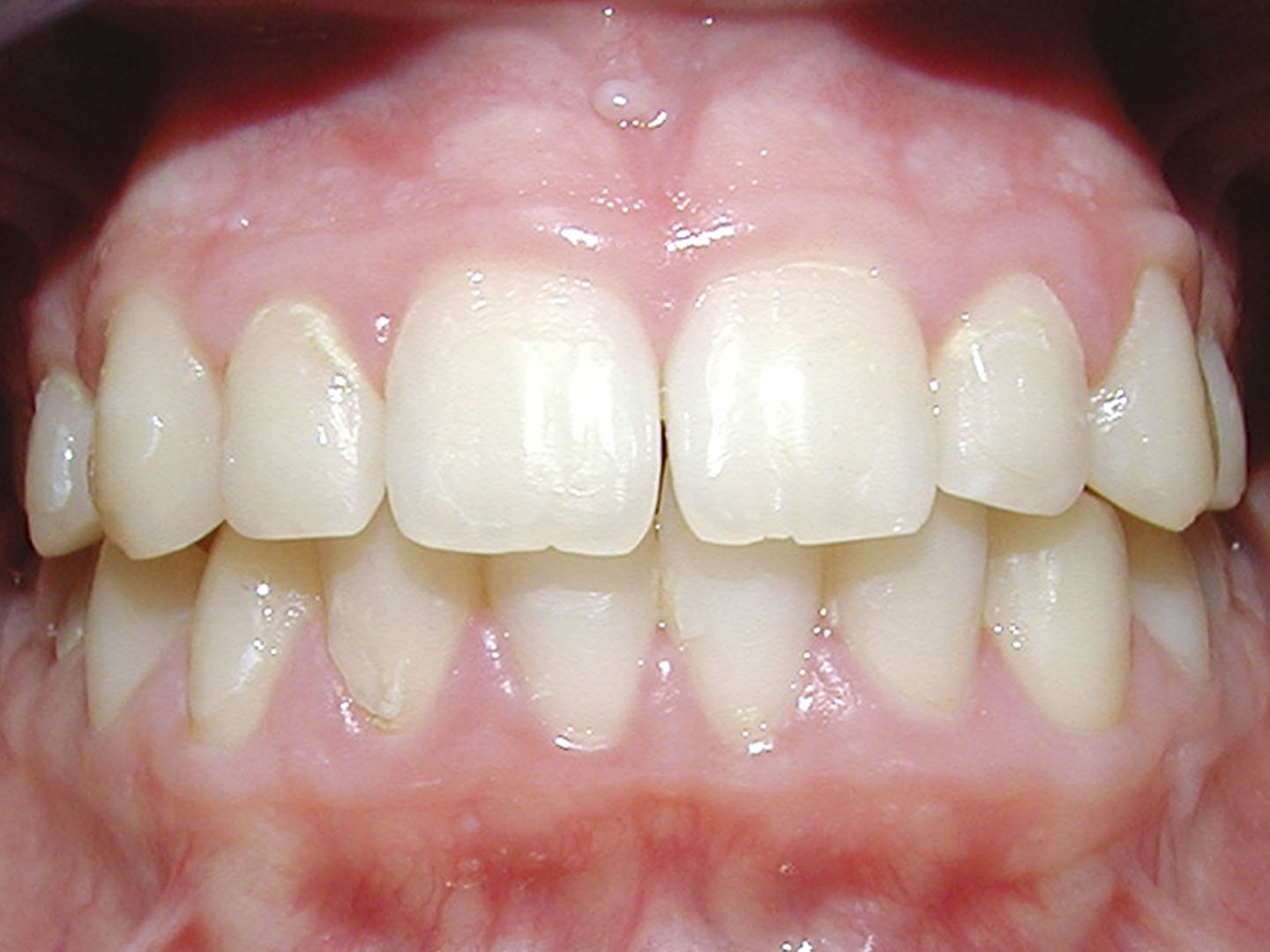 Dott.ssa Emanuela Muratore | Ortodonzia Dentale a Bellaria: dopo l’intervento – Caso 6