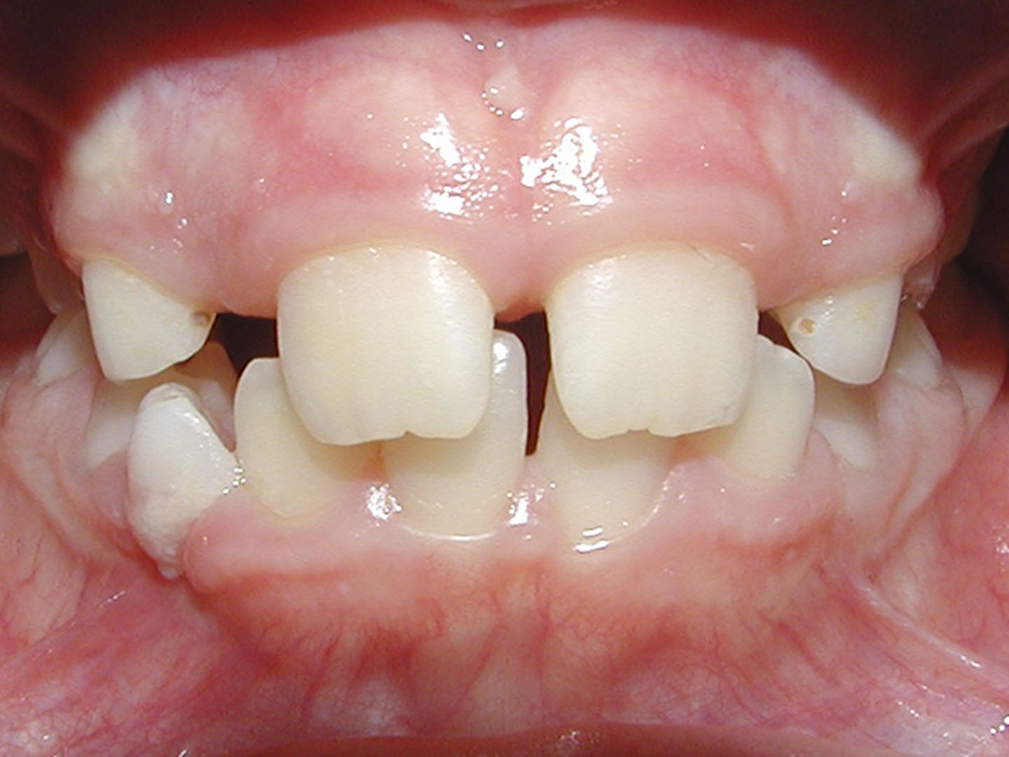 Dott.ssa Emanuela Muratore | Ortodonzia Dentale a Bellaria: prima dell’intervento – Caso 6