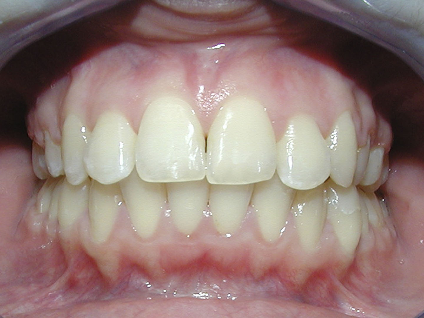 Dott.ssa Emanuela Muratore | Ortodonzia Dentale a Bellaria: dopo l’intervento – Caso 7