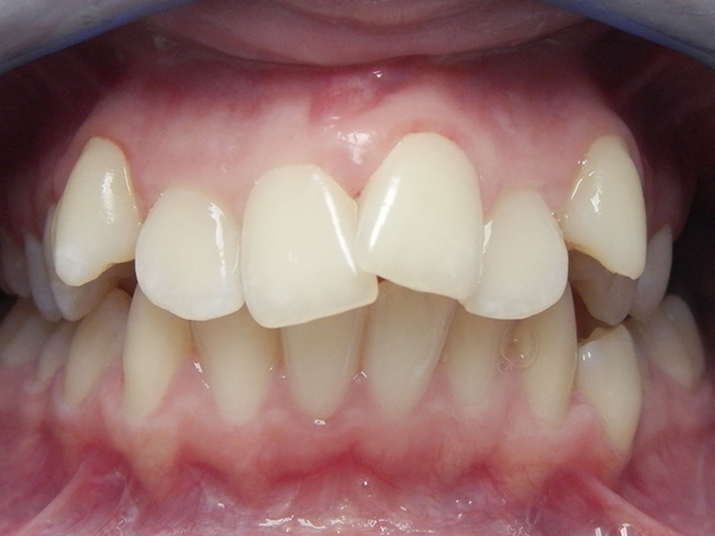 Dott.ssa Emanuela Muratore | Ortodonzia Dentale a Bellaria: prima dell’intervento – Caso 7