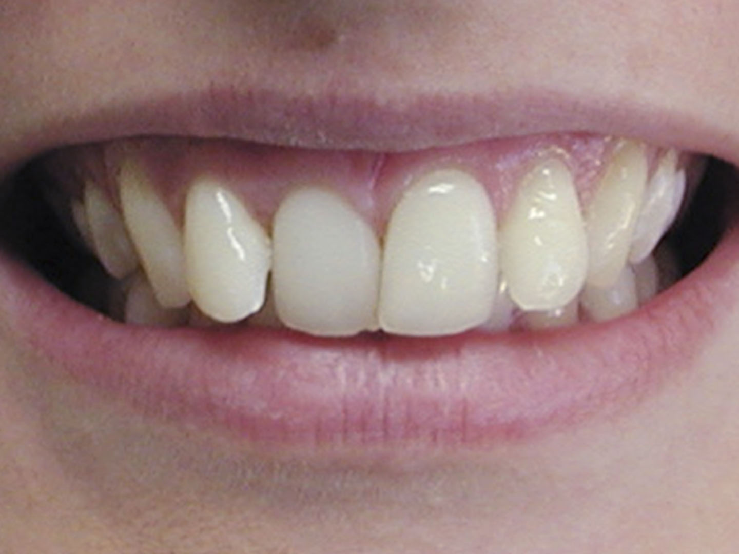 Dott.ssa Emanuela Muratore | Ortodonzia Dentale a Bellaria: prima dell’intervento – Caso 8