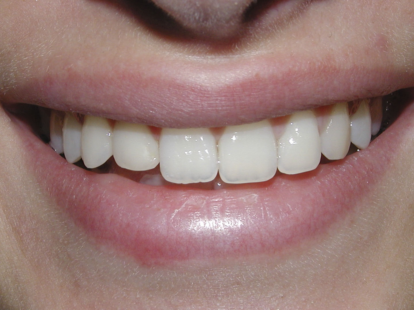 Dott.ssa Emanuela Muratore | Pulizia dei Denti a Bellaria: dopo l’intervento – Caso 1