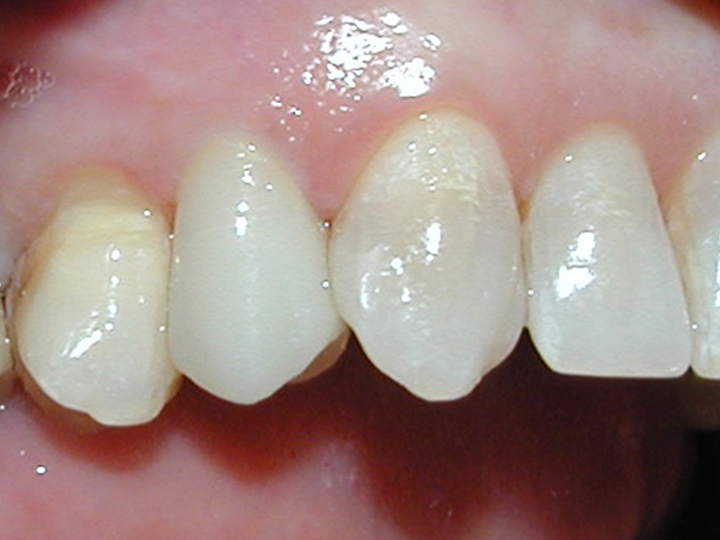 Dott.ssa Emanuela Muratore | Implantologia dentale a Bellaria: dopo l’intervento – Caso 3