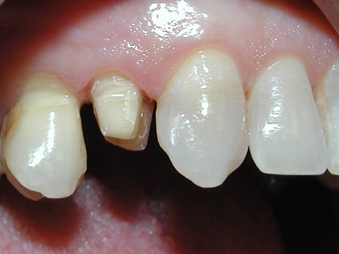 Dott.ssa Emanuela Muratore | Implantologia dentale a Bellaria: prima dell’intervento – Caso 3